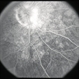 late-phase FA showing arteriolar attenuation and late staining of choroidal lesions